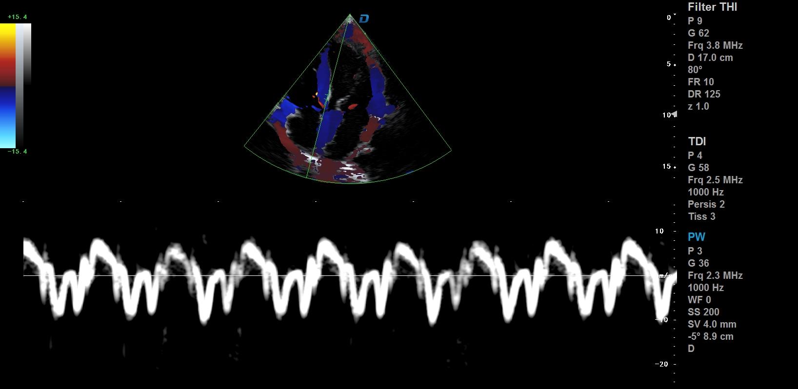 心臟彩超機和超聲心動圖的區(qū)別？